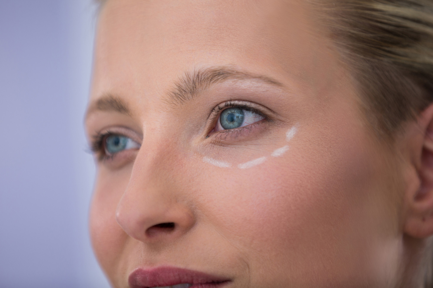 Close-up of eyes with dark circles, illustrating the topic of the article: Circles Under the Eyes: Causes & Solutions.