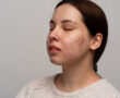 Information on different types of acne, facial blemishes, and their treatments.